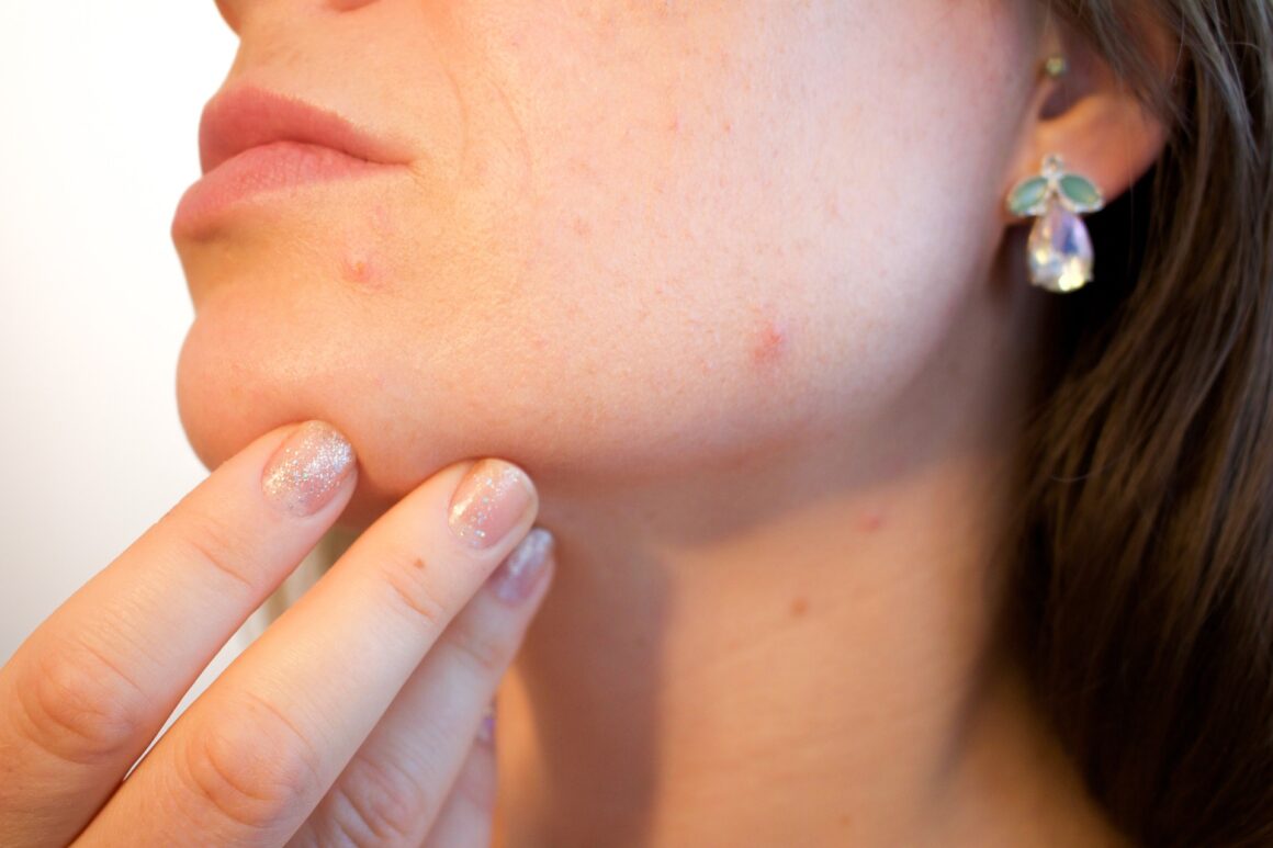 Acne e sole, quanto sono compatibili?