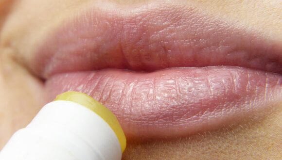 Herpes labiale: come trattarlo e cosa fare se recidiva