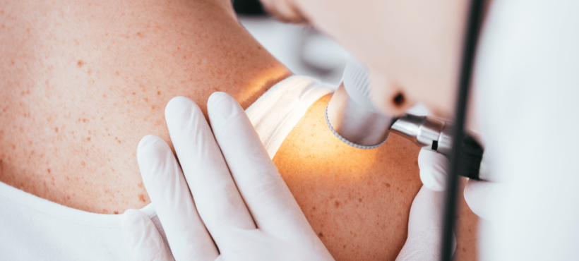 Melanoma: il ruolo di una proteina del plasma