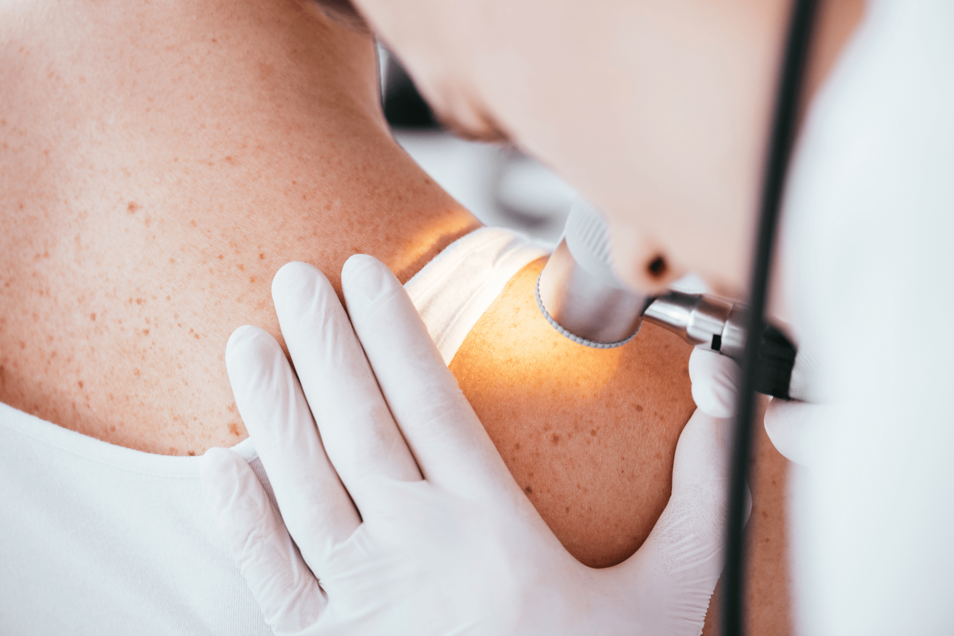 Melanoma: il ruolo di una proteina del plasma